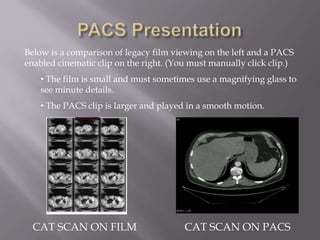PACS PresentationBelow is a comparison of legacy film viewing on the left and a PACS enabled cinematic clip on the right. (You must manually click clip.) The film is small and must sometimes use a magnifying glass to see minute details.