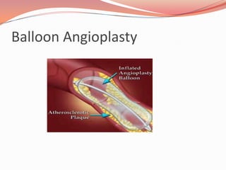 How Is a Stent ImplantedIf a stent is needed, it is usually implanted right after angioplasty, before the sheath is removedThe stent is usually mounted on a balloon catheterIt’s threaded into the coronary artery and placed at the site where the artery was widenedWhen the balloon inflated, the stent expands and presses against the inside wall of the arteryThe balloon is then deflated and removedThe stent remains in place, helping to keep the artery openOne or more stents may be used in the artery to span the length of the area where the narrowing wasIt’s a permanent implant that remains in the arteryWithin a few weeks, a thin layer of tissue will slowly grow over the stent and cover it