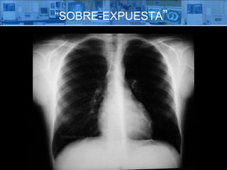 “ SOBRE-EXPUESTA ” 