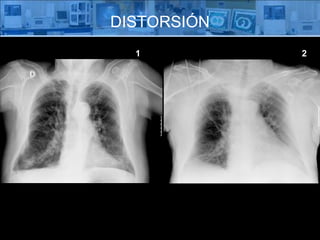 DISTORSIÓN 1 2 