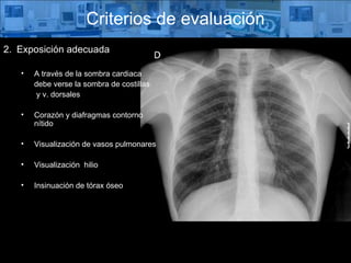 Exposición adecuada A través de la sombra cardiaca  debe verse la sombra de costillas   y v. dorsales Corazón y diafragmas contorno nítido Visualización de vasos pulmonares Visualización  hilio Insinuación de tórax óseo Criterios de evaluación 
