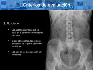Criterios de evaluación No rotación Las apófisis espinosas deben  estar en el centro de las vértebras lumbares  Si son observables, las espinas  Isquiáticas de la pelvis deben ser simétricas Las alas de los iliacos deben ser simétricas 
