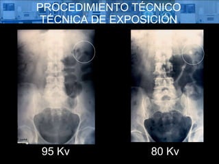 PROCEDIMIENTO TÉCNICO TÉCNICA DE EXPOSICIÓN 80 Kv 95 Kv 