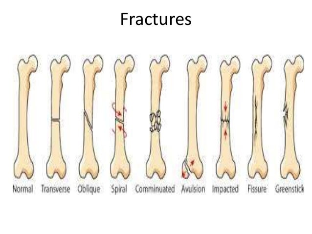 Chosen Fracture Types