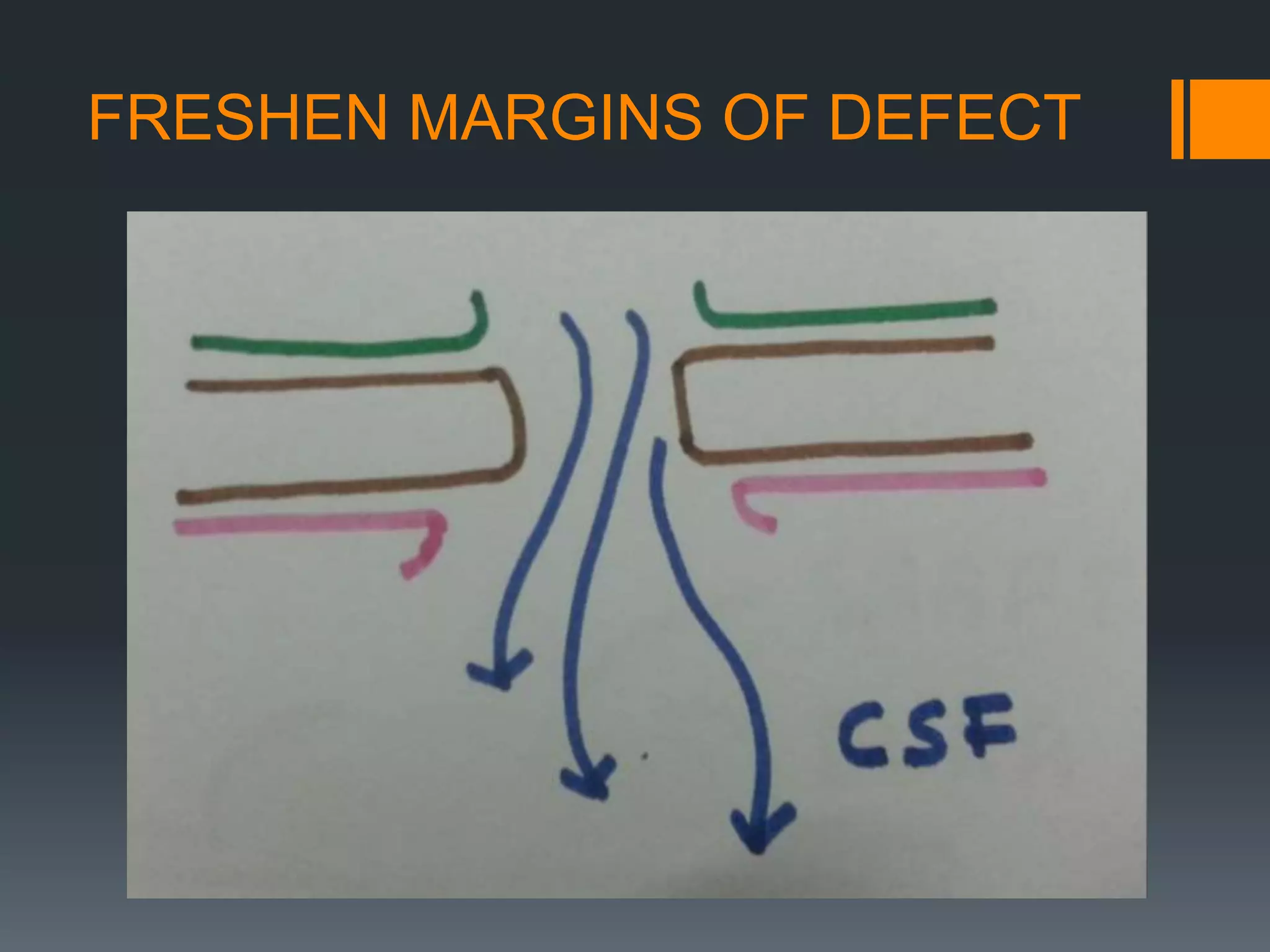 FRESHEN MARGINS OF DEFECT
 
