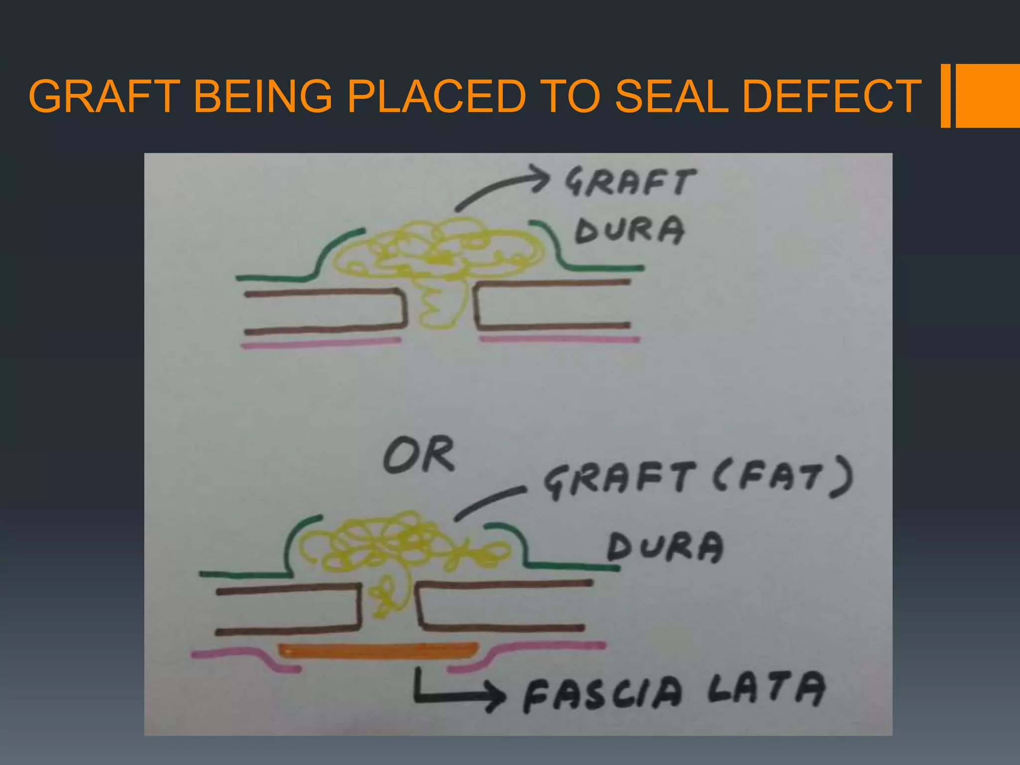 GRAFT BEING PLACED TO SEAL DEFECT
 