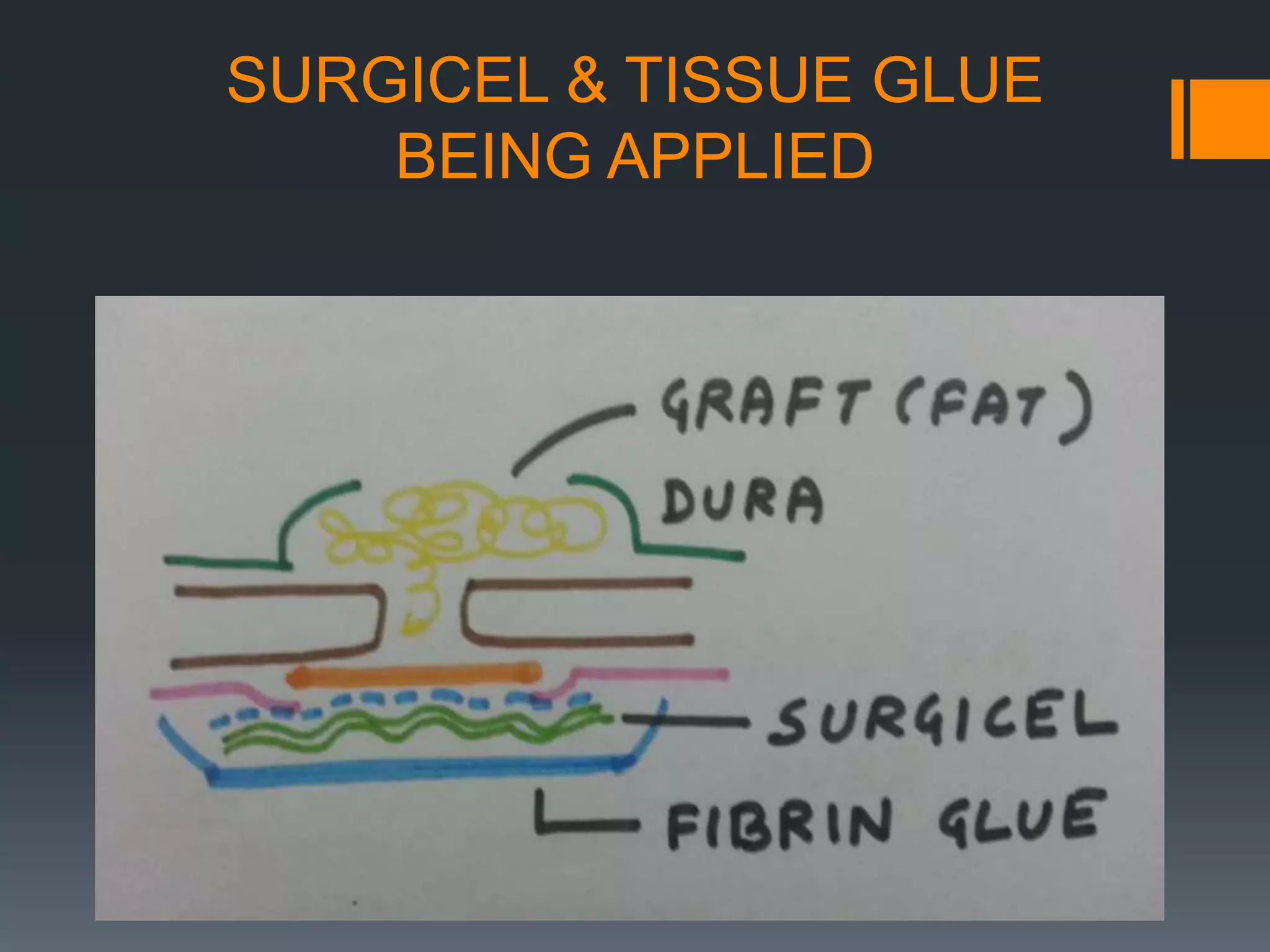 SURGICEL & TISSUE GLUE
BEING APPLIED
 