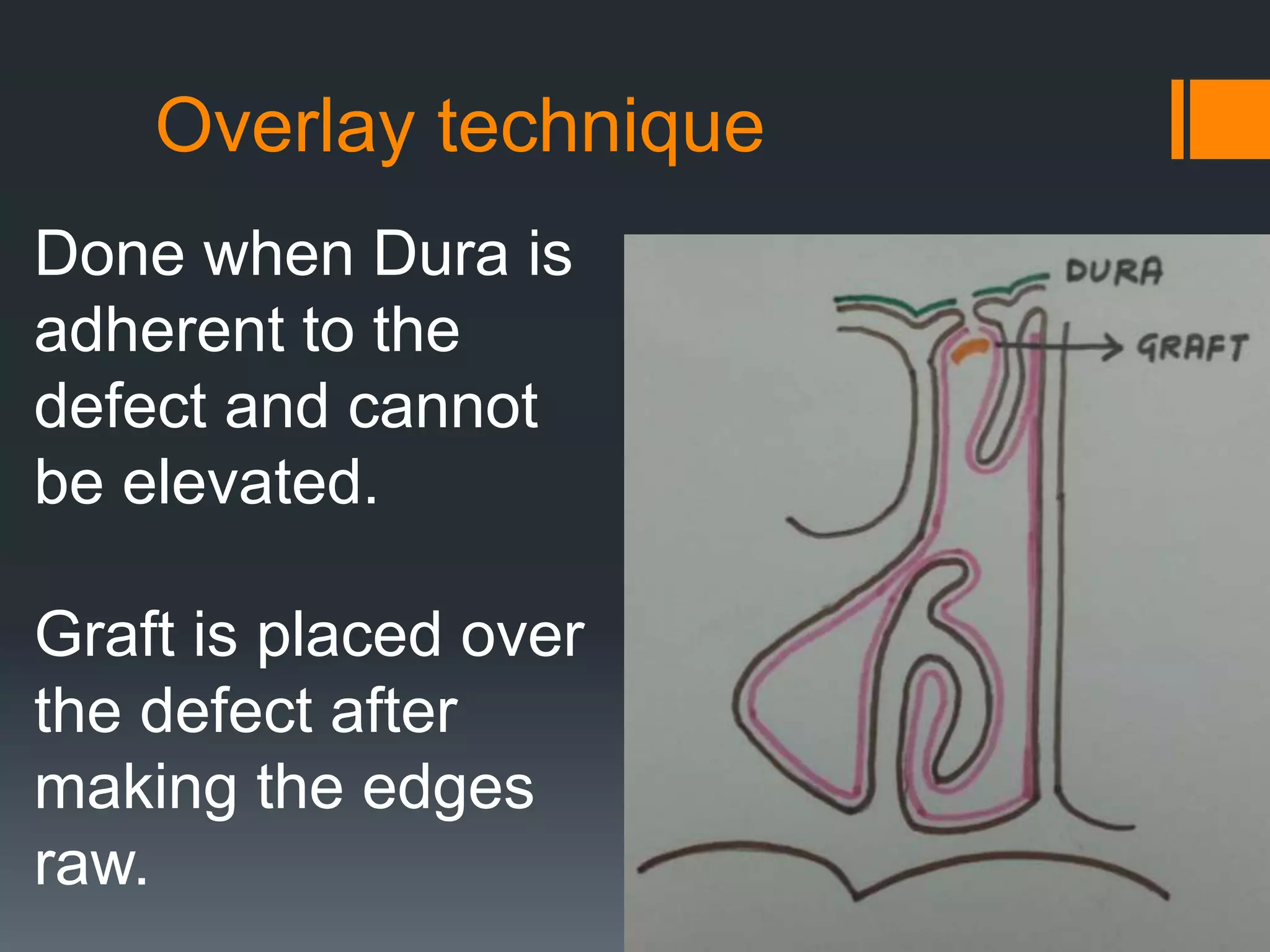 Overlay technique
Done when Dura is
adherent to the
defect and cannot
be elevated.
Graft is placed over
the defect after
making the edges
raw.
 