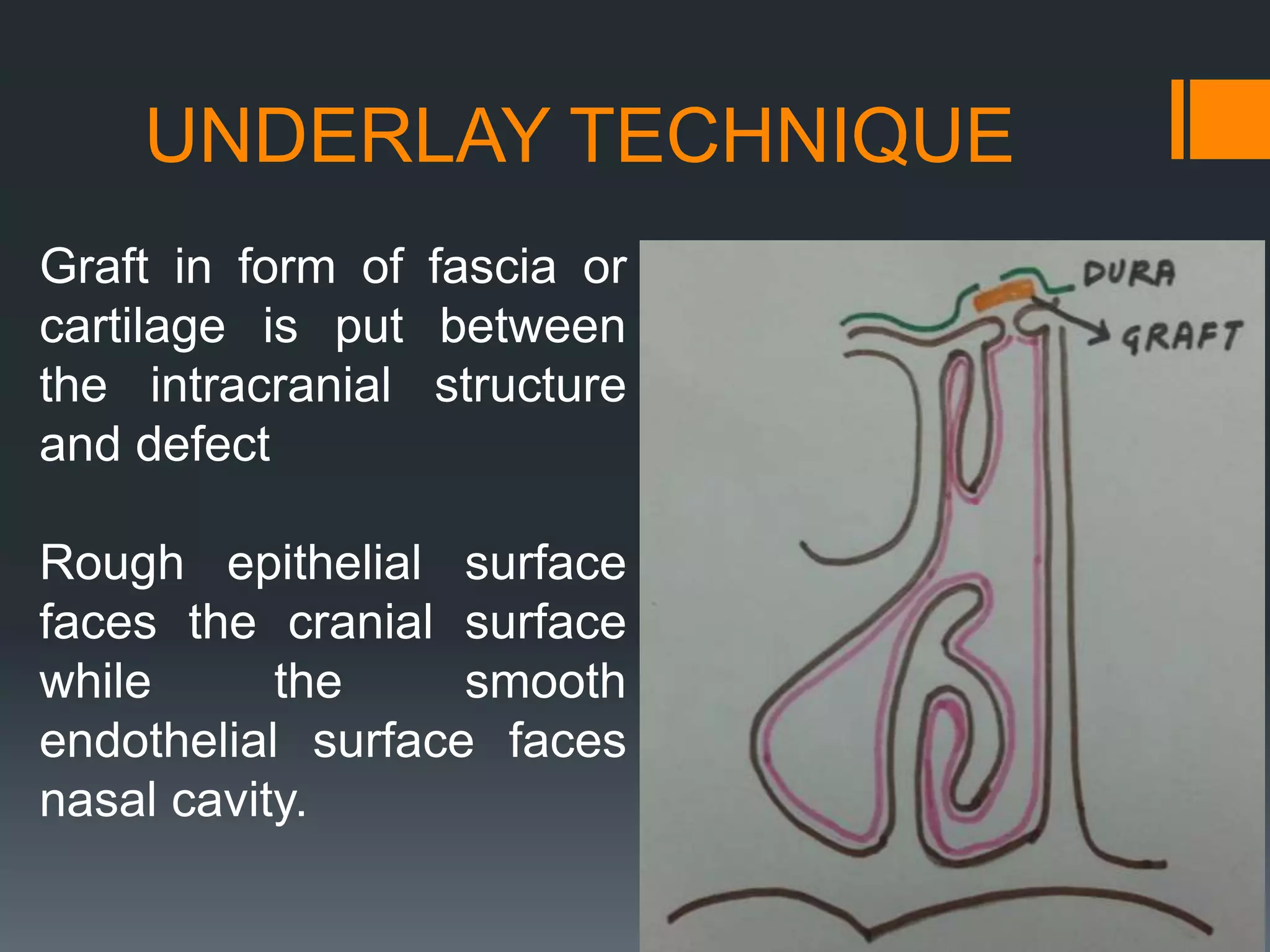 UNDERLAY TECHNIQUE
Graft in form of fascia or
cartilage is put between
the intracranial structure
and defect
Rough epithelial surface
faces the cranial surface
while the smooth
endothelial surface faces
nasal cavity.
 
