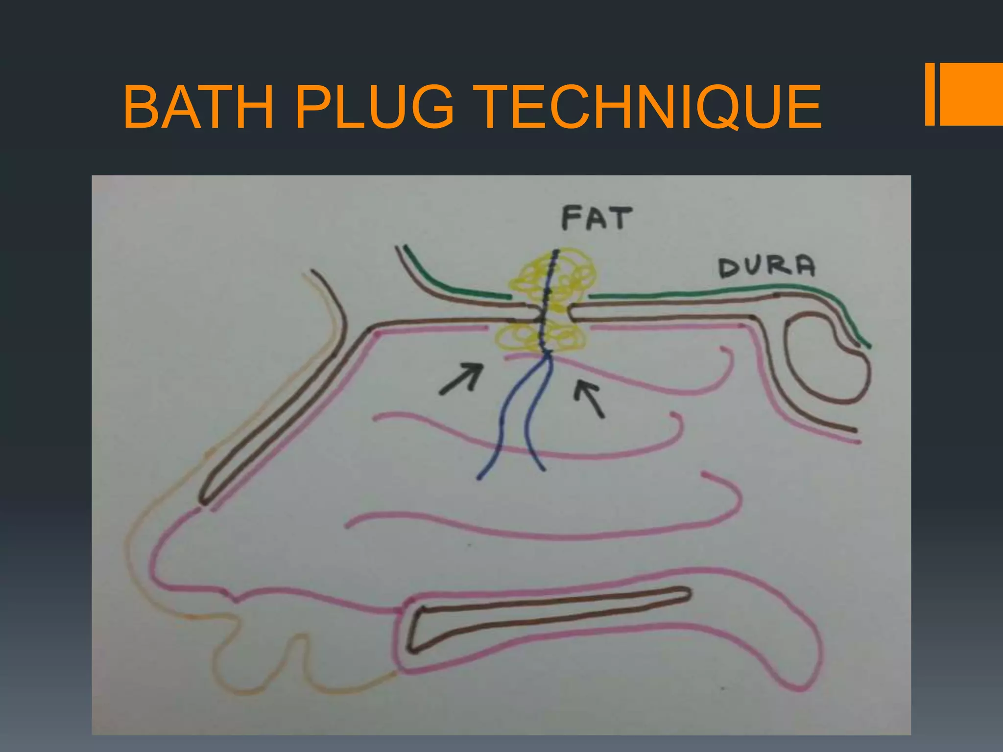 BATH PLUG TECHNIQUE
 
