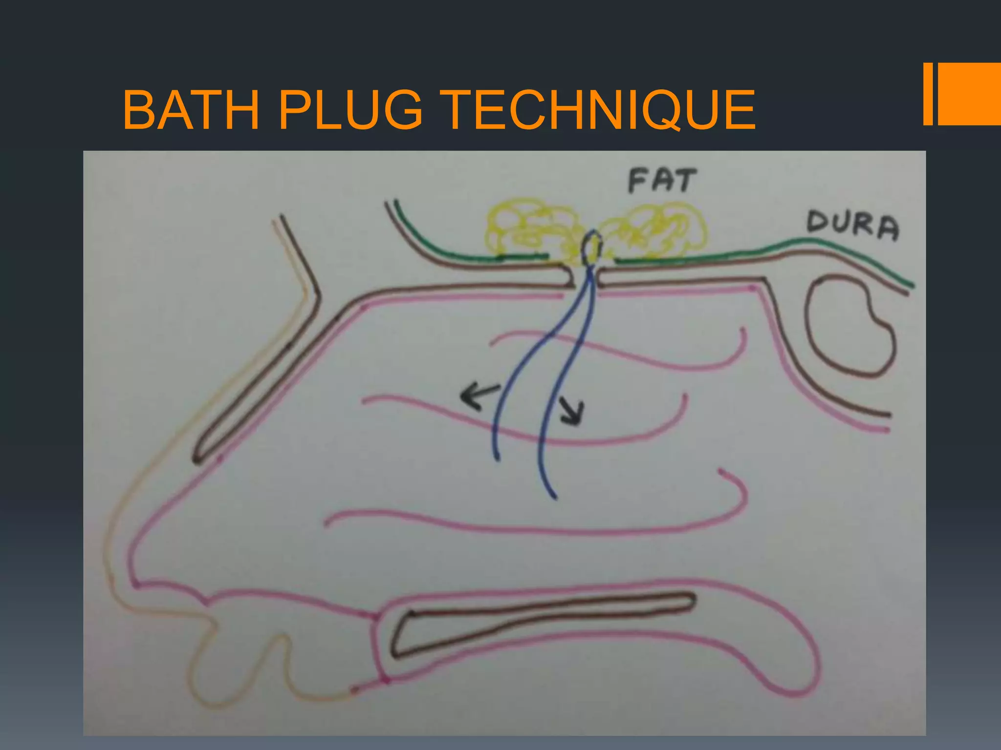BATH PLUG TECHNIQUE
 