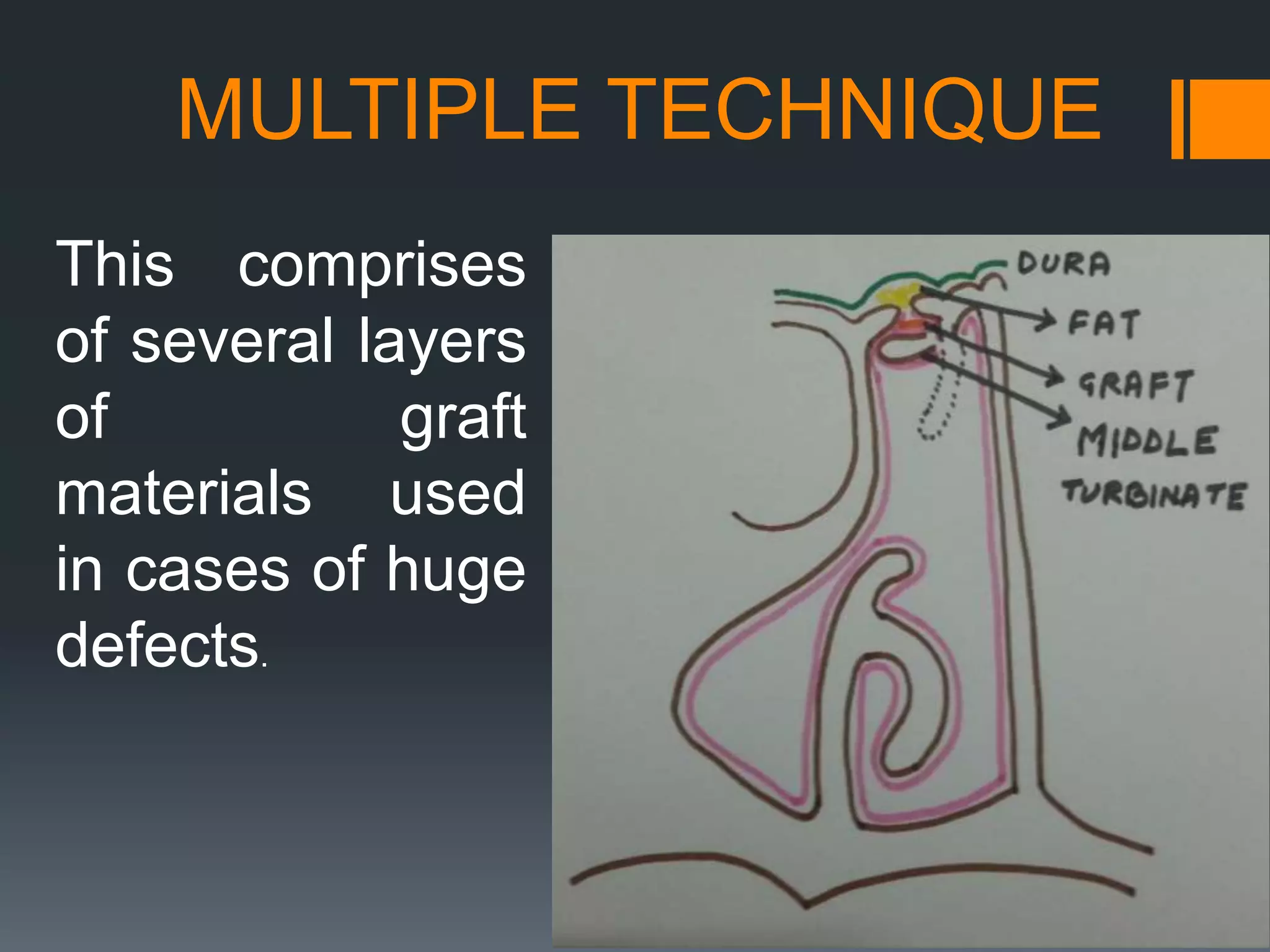 MULTIPLE TECHNIQUE
This comprises
of several layers
of graft
materials used
in cases of huge
defects.
 