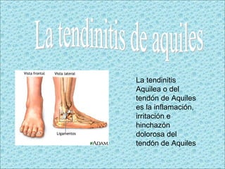 La tendinitis de aquiles La tendinitis Aquilea o del tendón de Aquiles es la inflamación, irritación e hinchazón dolorosa del tendón de Aquiles  