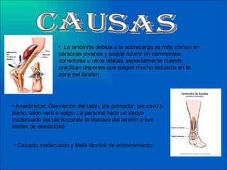 Causas La tendinitis debida a la sobrecarga es más común en personas jóvenes y puede ocurrir en caminantes, corredores u otros atletas, especialmente cuando practican deportes que exigen mucho esfuerzo en la zona del tendón  Anatómicos: Desviación del talón, pie pronador, pie cavo o plano, talón varo o valgo. La persona hace un apoyo inadecuado del pié forzando la tracción del tendón y sus limites de elasticidad  Calzado inadecuado y Mala técnica de entrenamiento 