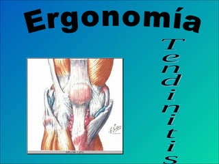 Ergonomía  Tendinitis  