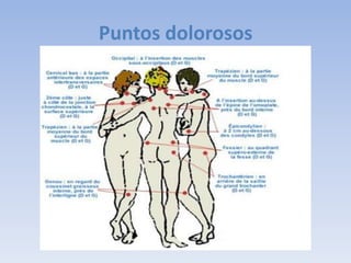 Puntos dolorosos
 