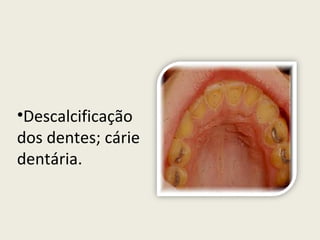 Descalcificação dos dentes; cárie dentária.  