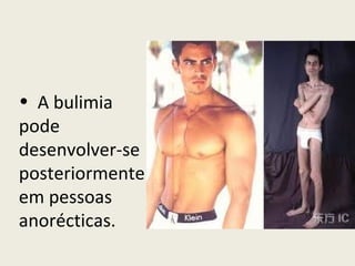 A bulimia pode desenvolver-se posteriormente em pessoas anorécticas.  