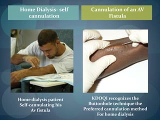 Fistula ComplicationsPainful cannulation, aneurysm, clotting, collapse/failure, infiltration, scar tissue, “bad sticks”, and difficult cannulation. Study concluded 72% of patients preferred the buttonholeTechnique to the rope-ladder technique. (Vazquez, 2009).