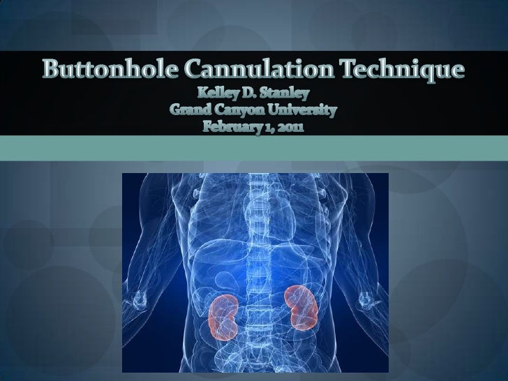 Buttonhole Cannulation Technique Power Point