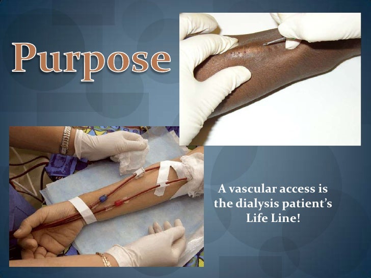 Buttonhole Cannulation Technique Power Point