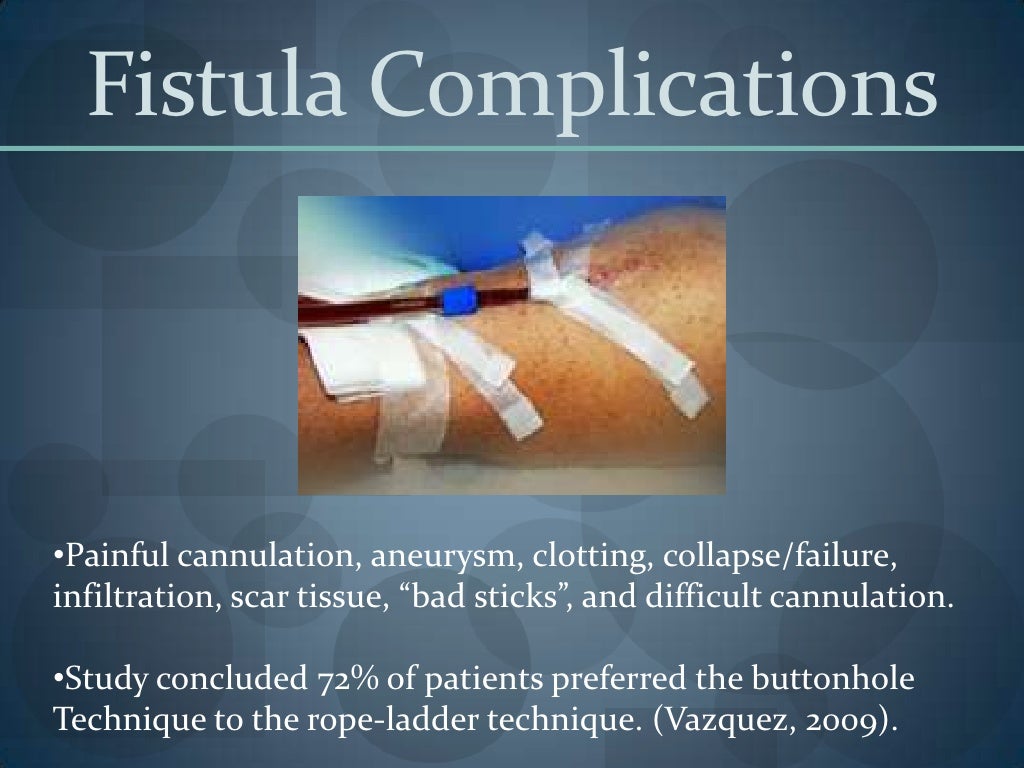 Buttonhole Cannulation Technique Power Point