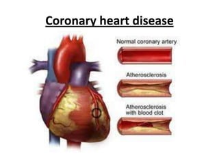 Coronaryheartdisease