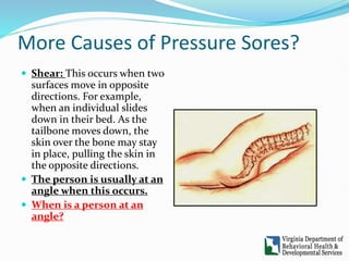 powerpoint forpromoting skin integrity and preventing pressure sores.pptx