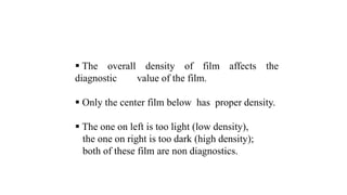  The overall density of film affects the
diagnostic value of the film.
 Only the center film below has proper density.
 The one on left is too light (low density),
the one on right is too dark (high density);
both of these film are non diagnostics.
 
