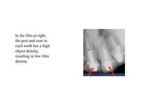 In the film at right,
the post and core in
each tooth has a high
object density,
resulting in low film
density.
 