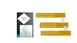 If the lack of parallelism
does not exceed 20,the
radiograph is generally
acceptable.
Place 1 or 2 cotton
rolls on bite block
Increase the vertical
angulation by 5 to 15
degree.
 
