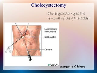 Cholecystectomy
       Cholecystectomy is the
       removal of the gallbladder




              Margarita C Rivera
 