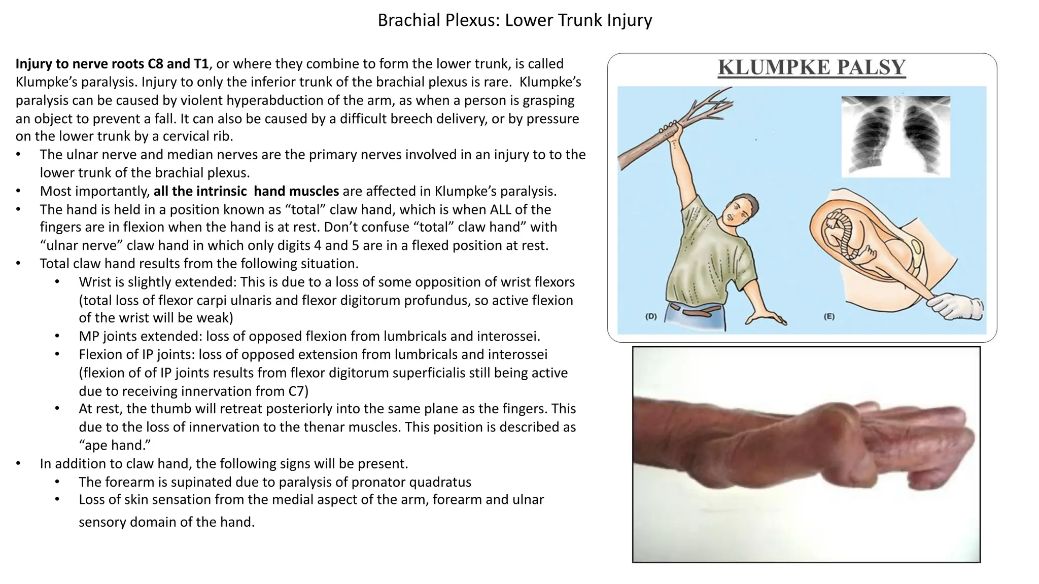 Injury to nerve roots C8 and T1, or where they combine to form the lower trunk, is called
Klumpke’s paralysis. Injury to only the inferior trunk of the brachial plexus is rare. Klumpke’s
paralysis can be caused by violent hyperabduction of the arm, as when a person is grasping
an object to prevent a fall. It can also be caused by a difficult breech delivery, or by pressure
on the lower trunk by a cervical rib.
• The ulnar nerve and median nerves are the primary nerves involved in an injury to to the
lower trunk of the brachial plexus.
• Most importantly, all the intrinsic hand muscles are affected in Klumpke’s paralysis.
• The hand is held in a position known as “total” claw hand, which is when ALL of the
fingers are in flexion when the hand is at rest. Don’t confuse “total” claw hand” with
“ulnar nerve” claw hand in which only digits 4 and 5 are in a flexed position at rest.
• Total claw hand results from the following situation.
• Wrist is slightly extended: This is due to a loss of some opposition of wrist flexors
(total loss of flexor carpi ulnaris and flexor digitorum profundus, so active flexion
of the wrist will be weak)
• MP joints extended: loss of opposed flexion from lumbricals and interossei.
• Flexion of IP joints: loss of opposed extension from lumbricals and interossei
(flexion of of IP joints results from flexor digitorum superficialis still being active
due to receiving innervation from C7)
• At rest, the thumb will retreat posteriorly into the same plane as the fingers. This
due to the loss of innervation to the thenar muscles. This position is described as
“ape hand.”
• In addition to claw hand, the following signs will be present.
• The forearm is supinated due to paralysis of pronator quadratus
• Loss of skin sensation from the medial aspect of the arm, forearm and ulnar
sensory domain of the hand.
Brachial Plexus: Lower Trunk Injury
 