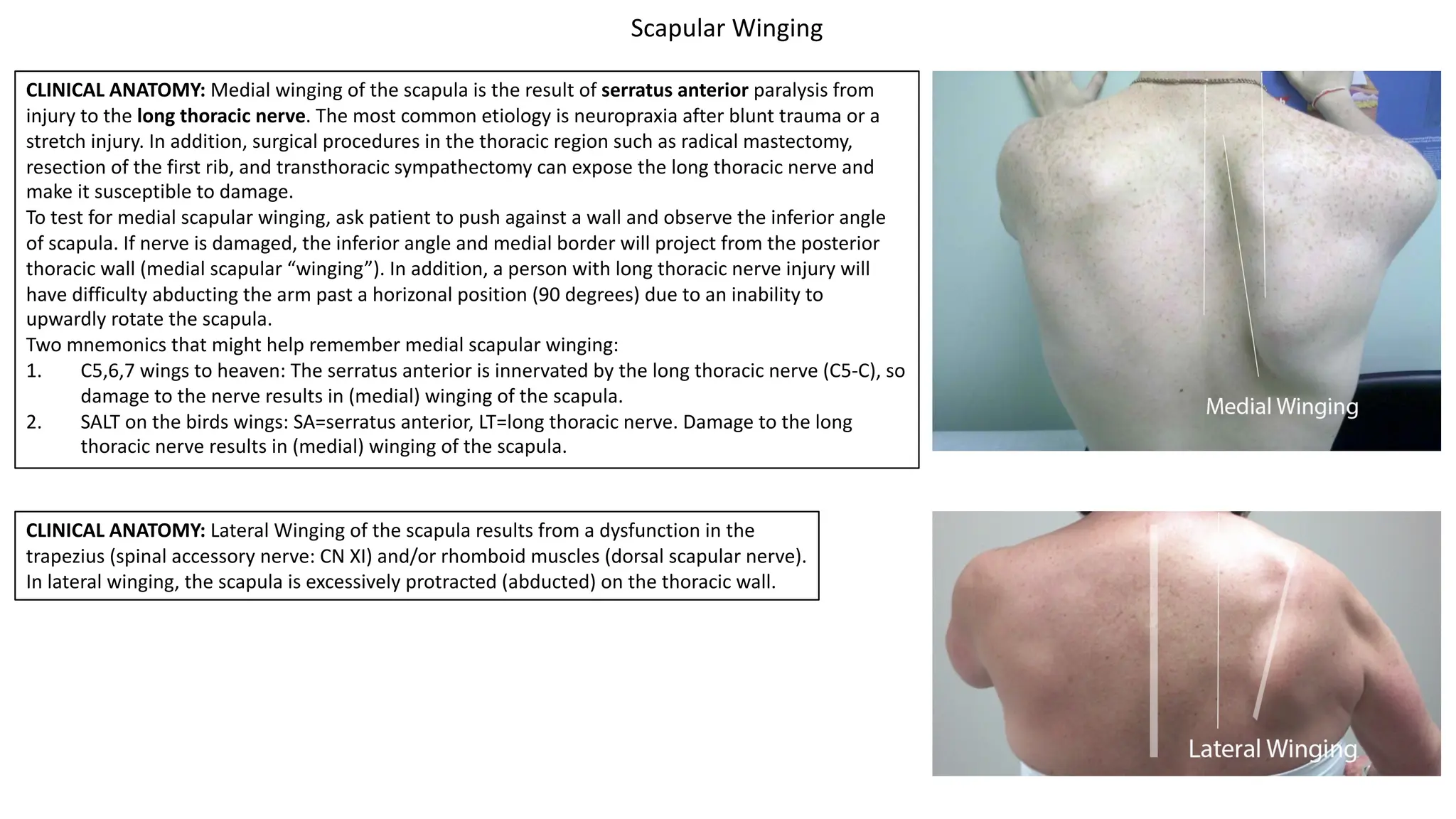 Scapular Winging
CLINICAL ANATOMY: Medial winging of the scapula is the result of serratus anterior paralysis from
injury to the long thoracic nerve. The most common etiology is neuropraxia after blunt trauma or a
stretch injury. In addition, surgical procedures in the thoracic region such as radical mastectomy,
resection of the first rib, and transthoracic sympathectomy can expose the long thoracic nerve and
make it susceptible to damage.
To test for medial scapular winging, ask patient to push against a wall and observe the inferior angle
of scapula. If nerve is damaged, the inferior angle and medial border will project from the posterior
thoracic wall (medial scapular “winging”). In addition, a person with long thoracic nerve injury will
have difficulty abducting the arm past a horizonal position (90 degrees) due to an inability to
upwardly rotate the scapula.
Two mnemonics that might help remember medial scapular winging:
1. C5,6,7 wings to heaven: The serratus anterior is innervated by the long thoracic nerve (C5-C), so
damage to the nerve results in (medial) winging of the scapula.
2. SALT on the birds wings: SA=serratus anterior, LT=long thoracic nerve. Damage to the long
thoracic nerve results in (medial) winging of the scapula.
CLINICAL ANATOMY: Lateral Winging of the scapula results from a dysfunction in the
trapezius (spinal accessory nerve: CN XI) and/or rhomboid muscles (dorsal scapular nerve).
In lateral winging, the scapula is excessively protracted (abducted) on the thoracic wall.
 