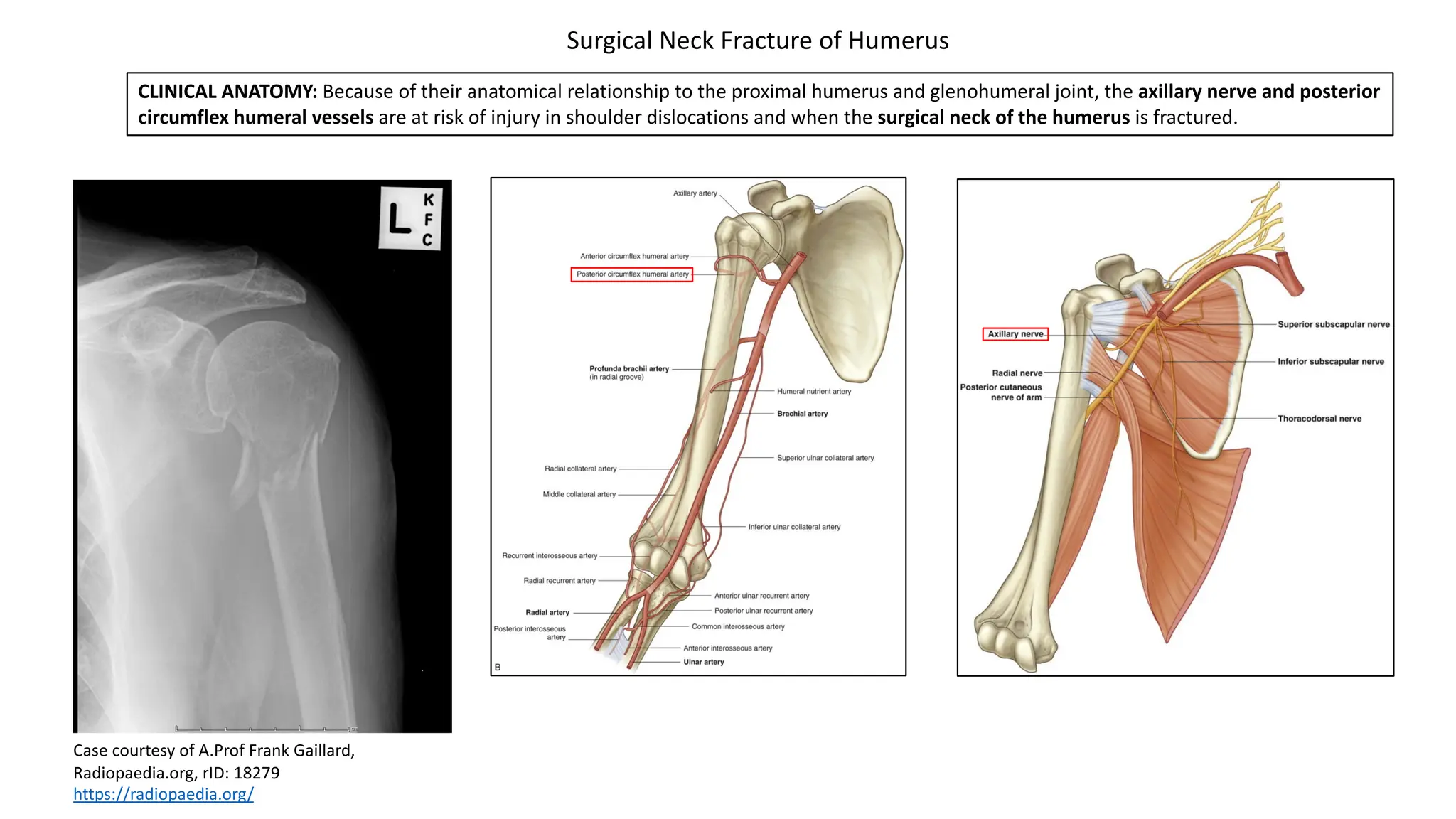 CLINICAL ANATOMY: Because of their anatomical relationship to the proximal humerus and glenohumeral joint, the axillary nerve and posterior
circumflex humeral vessels are at risk of injury in shoulder dislocations and when the surgical neck of the humerus is fractured.
Surgical Neck Fracture of Humerus
Case courtesy of A.Prof Frank Gaillard,
Radiopaedia.org, rID: 18279
https://radiopaedia.org/
 