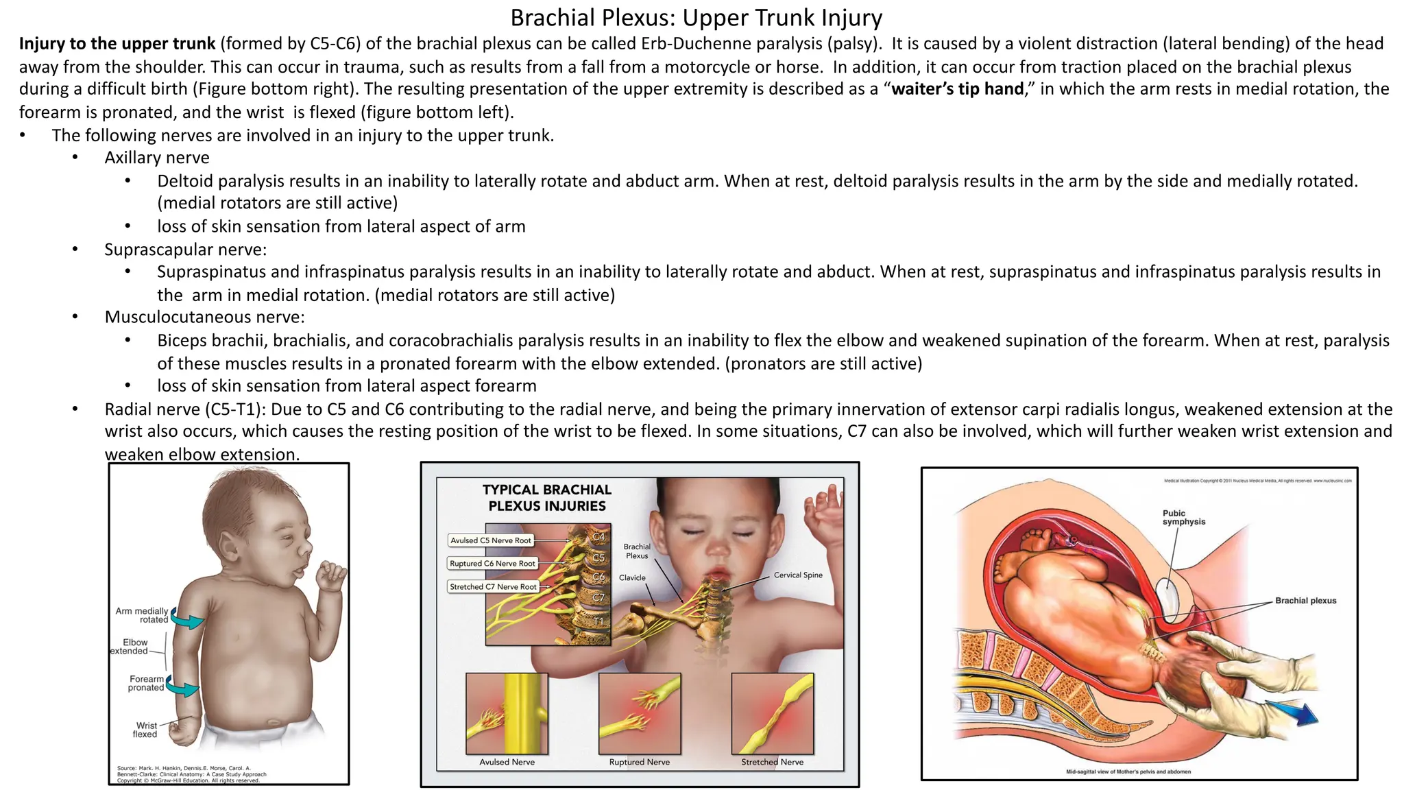 Injury to the upper trunk (formed by C5-C6) of the brachial plexus can be called Erb-Duchenne paralysis (palsy). It is caused by a violent distraction (lateral bending) of the head
away from the shoulder. This can occur in trauma, such as results from a fall from a motorcycle or horse. In addition, it can occur from traction placed on the brachial plexus
during a difficult birth (Figure bottom right). The resulting presentation of the upper extremity is described as a “waiter’s tip hand,” in which the arm rests in medial rotation, the
forearm is pronated, and the wrist is flexed (figure bottom left).
• The following nerves are involved in an injury to the upper trunk.
• Axillary nerve
• Deltoid paralysis results in an inability to laterally rotate and abduct arm. When at rest, deltoid paralysis results in the arm by the side and medially rotated.
(medial rotators are still active)
• loss of skin sensation from lateral aspect of arm
• Suprascapular nerve:
• Supraspinatus and infraspinatus paralysis results in an inability to laterally rotate and abduct. When at rest, supraspinatus and infraspinatus paralysis results in
the arm in medial rotation. (medial rotators are still active)
• Musculocutaneous nerve:
• Biceps brachii, brachialis, and coracobrachialis paralysis results in an inability to flex the elbow and weakened supination of the forearm. When at rest, paralysis
of these muscles results in a pronated forearm with the elbow extended. (pronators are still active)
• loss of skin sensation from lateral aspect forearm
• Radial nerve (C5-T1): Due to C5 and C6 contributing to the radial nerve, and being the primary innervation of extensor carpi radialis longus, weakened extension at the
wrist also occurs, which causes the resting position of the wrist to be flexed. In some situations, C7 can also be involved, which will further weaken wrist extension and
weaken elbow extension.
Brachial Plexus: Upper Trunk Injury
 