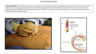 CLINICAL ANATOMY: An intercostal nerve block is an injection of a local anesthetic and/or corticosteroid around the intercostal nerve coursing in the
costal groove to manage pain involving the chest wall and the upper abdominal wall. An intercostal nerve block can be used to treat acute herpes
zoster, cancer pain, rib fractures, and post-thoracotomy pain. In addition, it can also be used as an anesthetic prior to the placement of percutaneous
thoracostomy and nephrotomy tubes.
Intercostal Nerve Block
 
