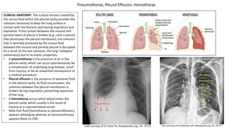 CLINICAL ANATOMY: The surface tension created by
the serous fluid within the pleural cavity provides the
cohesion necessary to keep the lung surface in
contact with the thoracic wall during inspiration and
expiration. If the contact between the visceral and
parietal layers of pleura is broken (e.g., with a wound
that penetrates the pleural membrane), the cohesion
that is normally produced by the serous fluid
between the visceral and parietal pleural is disrupted.
As a result of this lost cohesion, the lung "collapses"
(atelectasis) due to its elastic properties.
• A pneumothorax is the presence of air in the
pleural cavity, which can occur spontaneously, be
a complication of underlying lung disease, result
from trauma, or be an unwanted consequence of
a medical procedure.
• Pleural effusion is the presence of excessive fluid
in the pleural cavity. As fluid accumulates, the
cohesion between the pleural membranes is
broken during inspiration, preventing expansion
of the lung.
• A hemothorax occurs when blood enters the
pleural cavity, which usually is the result of
trauma or a ruptured blood vessel.
• Note that fluid (hemothorax or pleural effusions)
appears white/gray whereas air (pneumothorax)
appears black on CXR.
New Info
Case courtesy of Dr Muhanad Jaff, Radiopaedia.org, rID: 24722
Case courtesy of Dr Vivek Pai, Radiopaedia.org, rID: 27112
Pleural Effusion
Lung
Air in Pleural
Cavity =
Pneumothorax
Pneumothorax, Pleural Effusion, Hemothorax
 