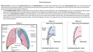 Lung
Lung
Pleural Recesses
Figure 2 Figure 3
Figure 1
Pleural recesses are spaces of the pleural cavity where the parietal pleura is in contact with itself and not the lung’s visceral pleura (Figure 2). The lung moves into
these spaces during inspiration (Figure 3) and retreats from the spaces during expiration (Figure 2). This expansion of the lung causes the lung to move inferiorly
about two rib levels during inspiration (Figure 3).
• The costodiaphragmatic recess is located where the costal pleura reflects onto the diaphragm. The costodiaphragmatic recess is considered a potential space
because it has the potential to collect fluid (pleural effusion) or microorganisms (empyema), which can be identified radiologically (next slide).
• The smaller, costomediastinal recesses are located posterior to the sternum where the costal parietal pleura contacts the mediastinal parietal pleura. The left
recess is larger because of the cardiac notch on the left lung. Due to the removal of the anterior thoracic wall, the costomediastinal recesses are not typically
identifiable in the formaldehyde preserved cadaver. Like the diaphragmatic recesses, the lungs will move into these spaces during inspiration and retreat from
them during expiration.
 