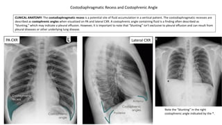 CLINICAL ANATOMY: The costodiaphragmatic recess is a potential site of fluid accumulation in a vertical patient. The costodiaphragmatic recesses are
described as costophrenic angles when visualized on PA and lateral CXR. A costophrenic angle containing fluid is a finding often described as
“blunting,” which may indicate a pleural effusion. However, it is important to note that “blunting” isn’t exclusive to pleural effusion and can result from
pleural diseases or other underlying lung disease.
Note the ”blunting” in the right
costophrenic angle indicated by the *.
PA CXR Lateral CXR
Costodiaphragmatic Recess and Costophrenic Angle
*
 
