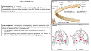 CLINICAL ANATOMY: Rib Fractures
The weakest part of a rib is just anterior to the costal angle (Figure 1). Rib fractures
commonly result from direct impact or indirectly from crush injuries. The middle ribs are
most commonly injured.
CLINICAL ANATOMY: Flail chest refers to the paradoxical movement of a portion of the
thoracic wall that accompanies fractures of multiple ribs. Fracturing 3 consecutive ribs in
2 places on each rib, results in flail chest (Figure 2).
• The flail segment of chest wall moves inward on inspiration and outward on
expiration.
• Flail chest is extremely painful and impairs ventilation because the “flail” segment of
the chest wall is unable to contribute to ventilation and lung expansion.
Osseous Thorax: Ribs Figure 1
Figure 2
 