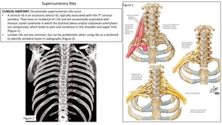 CLINICAL ANATOMY: Occasionally supernumerary ribs occur.
• A cervical rib is an accessory (extra) rib, typically associated with the 7th cervical
vertebra. They have an incidence of <1% and are occasionally associated with
thoracic outlet syndrome in which the brachial plexus and/or subclavian artery/vein
are compressed, which leads to pain and numbness in the shoulder and upper limb
(Figure 1).
• Lumbar ribs are less common, but can be problematic when using ribs as a landmark
to identify vertebral levels in radiographs (Figure 2).
Figure 1
Figure 2
Supernumerary Ribs
 