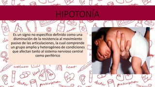 HIPOTONÍA
Es un signo no específico definido como una
disminución de la resistencia al movimiento
pasivo de las articulaciones, la cual comprende
un grupo amplio y heterogéneo de condiciones
que afectan tanto al sistema nervioso central
como periférico
 