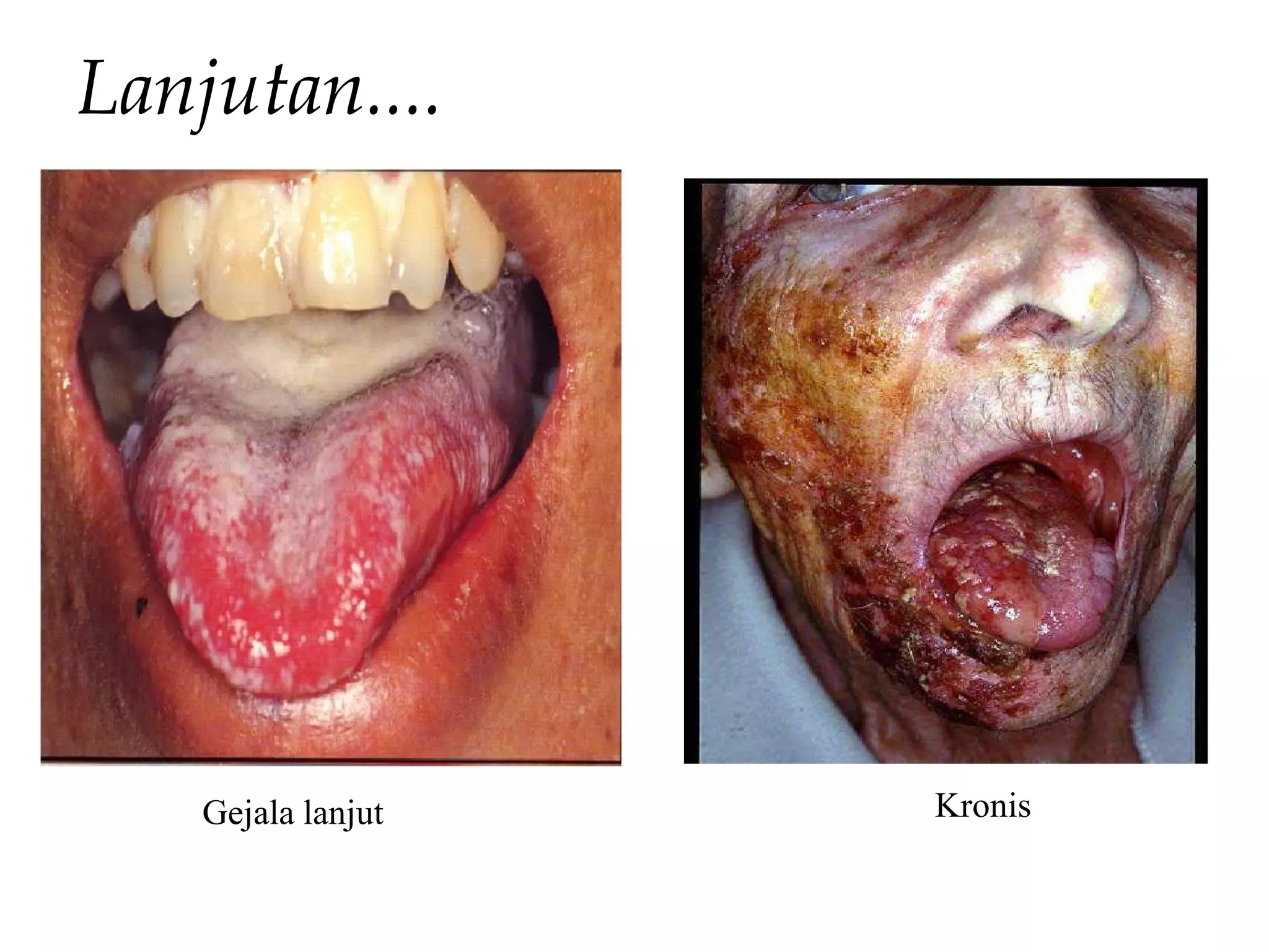 Lanjutan....
Gejala lanjut Kronis
 