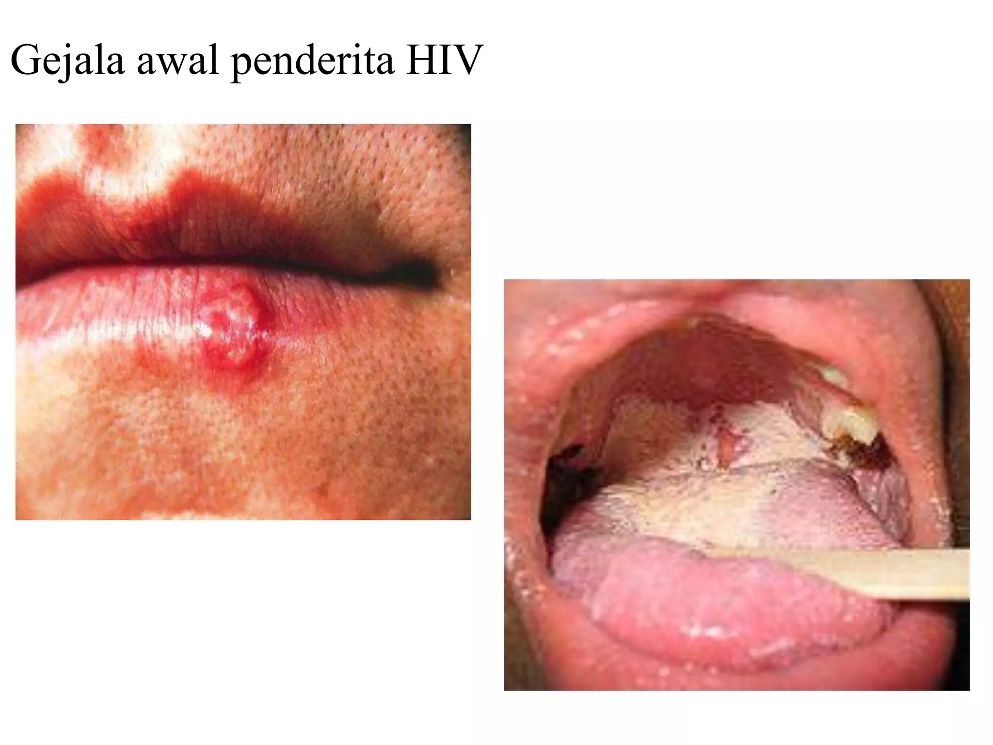 Gejala awal penderita HIV
 