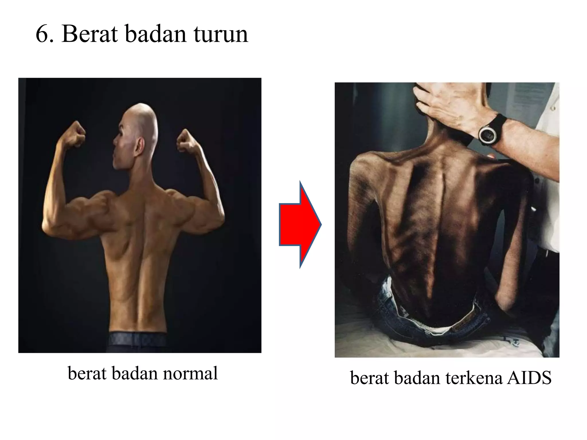 6. Berat badan turun
berat badan normal berat badan terkena AIDS
 