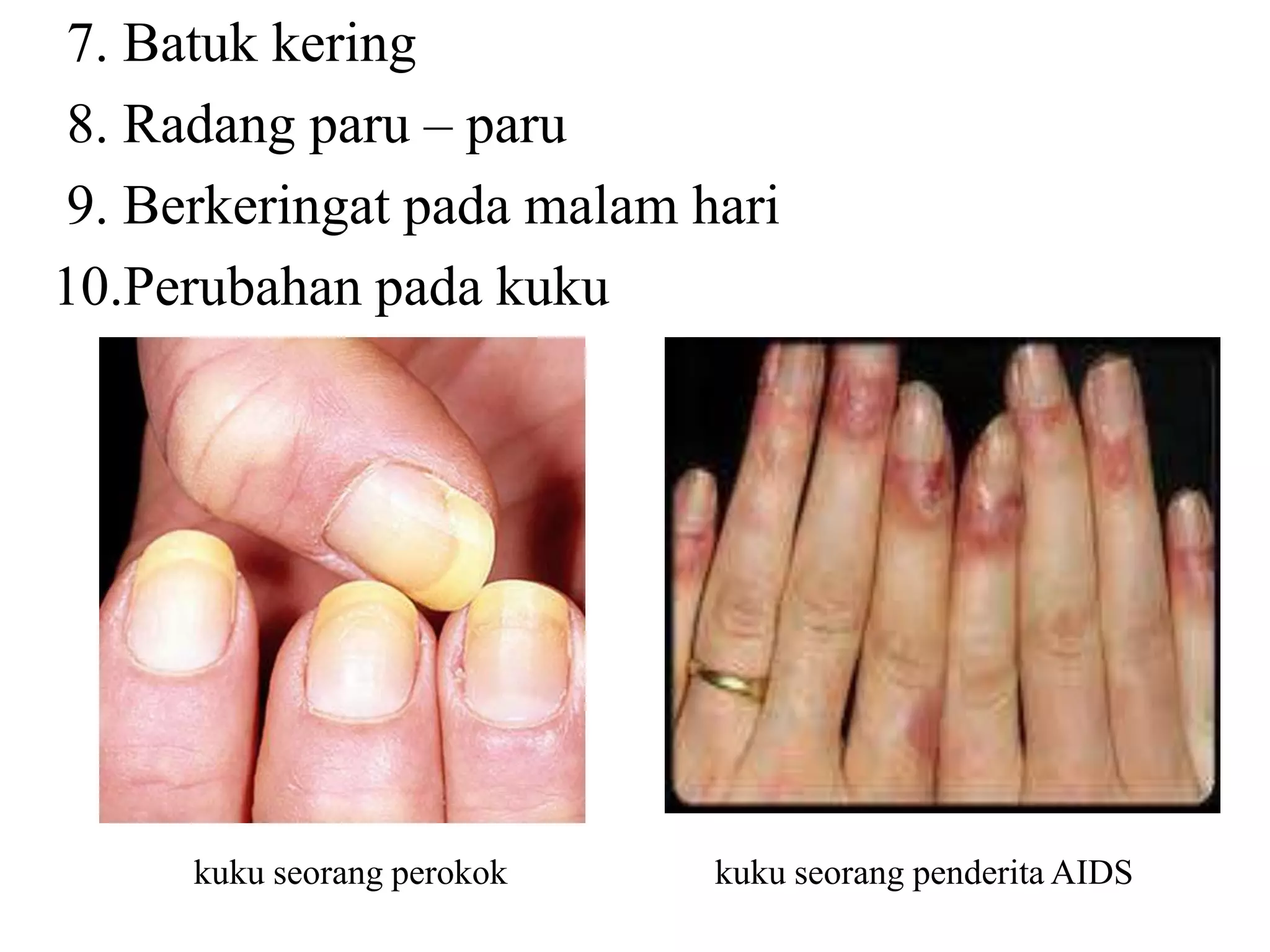 7. Batuk kering
8. Radang paru – paru
9. Berkeringat pada malam hari
10.Perubahan pada kuku
kuku seorang perokok kuku seorang penderita AIDS
 