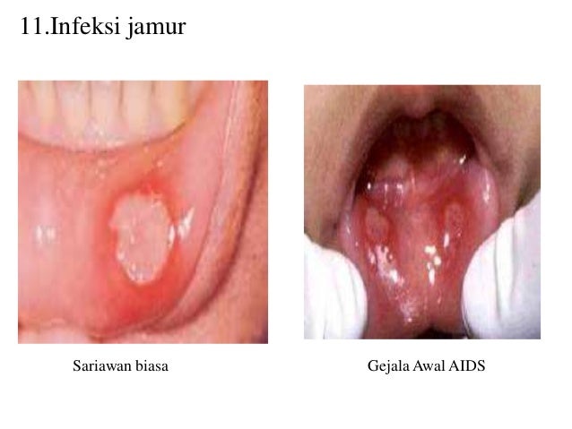 Power Point Hiv Aids