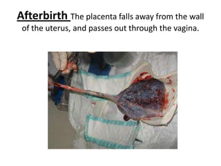 Afterbirth The placenta falls away from the wall
of the uterus, and passes out through the vagina.
 