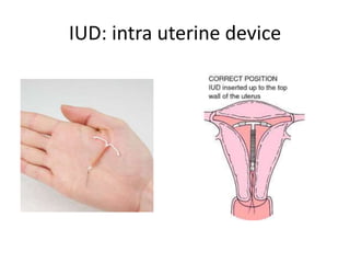 IUD: intra uterine device
 